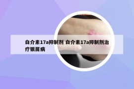 白介素17a抑制劑 白介素17a抑制劑治療銀屑病