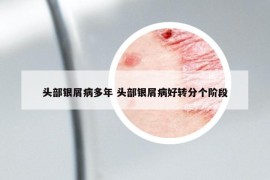 頭部銀屑病多年 頭部銀屑病好轉(zhuǎn)分個(gè)階段