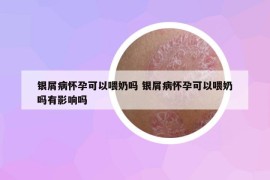 銀屑病懷孕可以喂奶嗎 銀屑病懷孕可以喂奶嗎有影響嗎