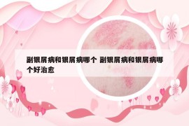 副銀屑病和銀屑病哪個 副銀屑病和銀屑病哪個好治愈