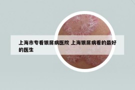 上海市?？淬y屑病醫(yī)院 上海銀屑病看的最好的醫(yī)生