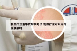 刺血療法治牛皮癬的方法 刺血療法可以治療皮膚病嗎