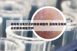 洛陽(yáng)有沒(méi)有好點(diǎn)的銀屑病醫(yī)院 洛陽(yáng)有沒(méi)有好點(diǎn)的銀屑病醫(yī)院啊
