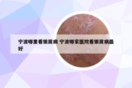 寧波哪里看銀屑病 寧波哪家醫(yī)院看銀屑病最好