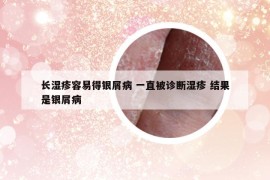 長濕疹容易得銀屑病 一直被診斷濕疹 結果是銀屑病