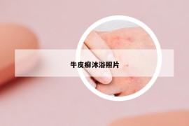 牛皮癬沐浴照片
