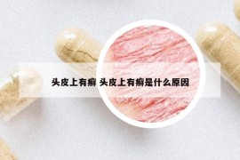 頭皮上有癬 頭皮上有癬是什么原因