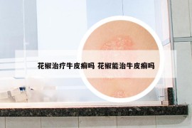 花椒治療牛皮癬嗎 花椒能治牛皮癬嗎