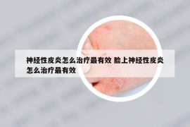 神經(jīng)性皮炎怎么治療最有效 臉上神經(jīng)性皮炎怎么治療最有效