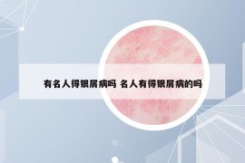 有名人得銀屑病嗎 名人有得銀屑病的嗎