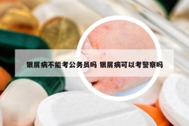 銀屑病不能考公務員嗎 銀屑病可以考警察嗎