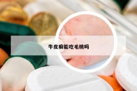 牛皮癬能吃毛桃嗎