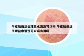 牛皮膚癬涂生理鹽水清洗可以嗎 牛皮膚癬涂生理鹽水清洗可以嗎有用嗎