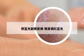 照藍(lán)光副銀屑病 銀屑病紅藍(lán)光