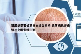 銀屑病需要長期補充維生素嗎 銀屑病患者應(yīng)該補充哪些維生素