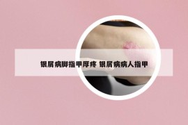 銀屑病腳指甲厚疼 銀屑病病人指甲
