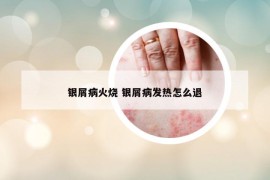銀屑病火燒 銀屑病發(fā)熱怎么退