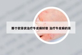 那個(gè)軟膏狀治療牛皮癬好些 治療牛皮癬的膏