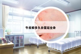 牛皮癬多久會(huì)蔓延全身