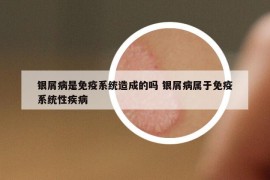 銀屑病是免疫系統(tǒng)造成的嗎 銀屑病屬于免疫系統(tǒng)性疾病
