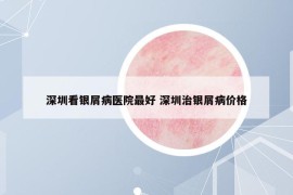 深圳看銀屑病醫(yī)院最好 深圳治銀屑病價格