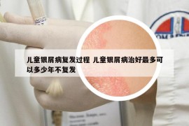 兒童銀屑病復(fù)發(fā)過程 兒童銀屑病治好最多可以多少年不復(fù)發(fā)