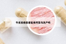牛皮皮癬患者能用何首烏洗產(chǎn)嗎