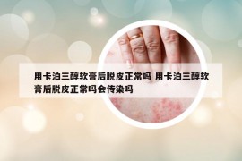 用卡泊三醇軟膏后脫皮正常嗎 用卡泊三醇軟膏后脫皮正常嗎會(huì)傳染嗎
