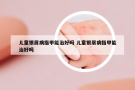 兒童銀屑病指甲能治好嗎 兒童銀屑病指甲能治好嗎