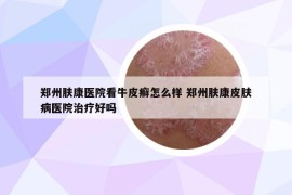 鄭州膚康醫(yī)院看牛皮癬怎么樣 鄭州膚康皮膚病醫(yī)院治療好嗎
