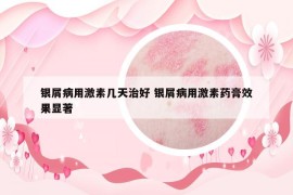 銀屑病用激素幾天治好 銀屑病用激素藥膏效果顯著