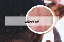古經(jīng)方牛皮癬