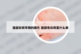 腿部白斑早期的圖片 腿部有白斑是什么病