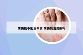 生姜能不能治牛皮 生姜能治皮癬嗎