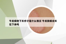 牛皮癬地下長癤子是什么情況 牛皮膚癬會長在下身嗎