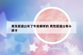 男生尿道口長(zhǎng)了牛皮癬樣的 男性尿道口有小疹子
