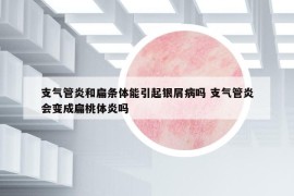 支氣管炎和扁條體能引起銀屑病嗎 支氣管炎會變成扁桃體炎嗎