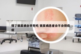 得了銀屑病會(huì)早死嗎 銀屑病患者會(huì)不會(huì)得癌癥