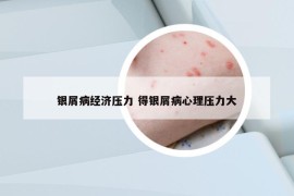 銀屑病經(jīng)濟(jì)壓力 得銀屑病心理壓力大