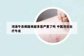 泡澡牛皮癬越來越多是嚴(yán)重了嗎 中醫(yī)泡浴治療牛皮