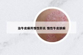 治牛皮癬開慢性肝炎 慢性牛皮膚癬