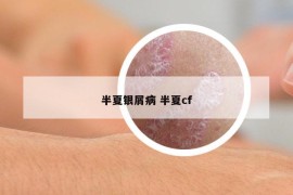 半夏銀屑病 半夏cf