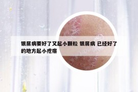 銀屑病要好了又起小顆粒 銀屑病 已經(jīng)好了的地方起小疙瘩