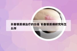 長(zhǎng)春銀屑病治療的價(jià)格 長(zhǎng)春銀屑病研究所怎么樣