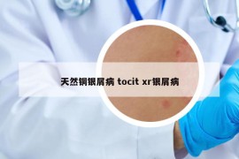 天然銅銀屑病 tocit xr銀屑病