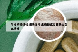牛皮癬潰瘍性結(jié)腸炎 牛皮癬潰瘍性結(jié)腸炎怎么治療