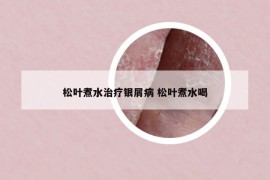 松葉煮水治療銀屑病 松葉煮水喝