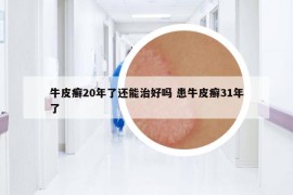 牛皮癬20年了還能治好嗎 患牛皮癬31年了