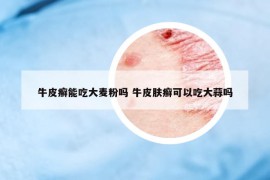 牛皮癬能吃大麥粉嗎 牛皮膚癬可以吃大蒜嗎