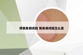得銀屑病誘因 銀屑病誘因怎么查
